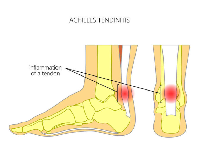 Achilles Tendonitis Treatment Podiatrist In King Of Prussia