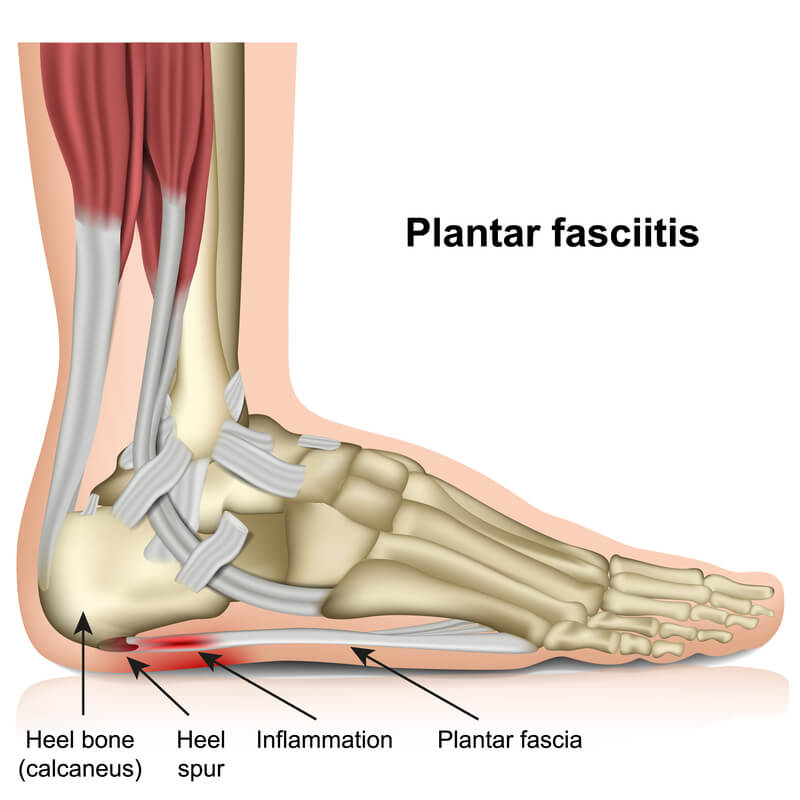 Plantar Fasciitis Treatment in Westminster