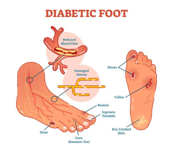 Dr. Hess Diabetic Foot Cream - Advanced Formula, 4.5 Oz – Dr Hess